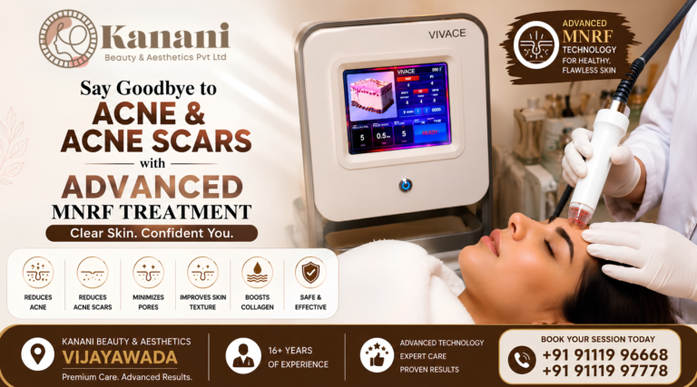 Best MNRF Treatment for Acne Scars in Vijayawada